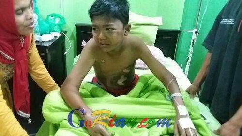 Kulit Pelajar SD Duri Timur Gosong Terkena Sentrum