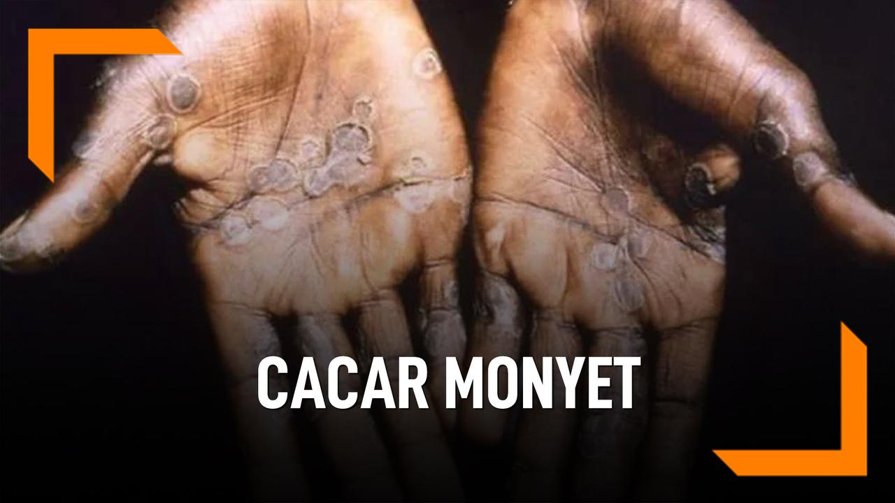 Cara Mencegah Cacar Monyet Dengan Cara Ini