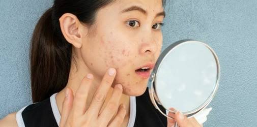 Dengan Bahan Alami, Ini 11 Cara Cepat Menghilangkan Jerawat