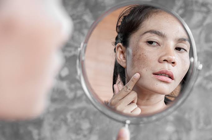 Memasuki Usia 40-an? Ini Cara Menghilangkan Flek Hitam di Wajah